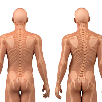 脊柱側弯症(Scoliosis)
